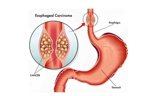 Esophageal-Carcinoma-Overview-and-Statistics.png 473d9aa3-fbe8-40ff-9e8d-81ed999ba4c2.png.png
