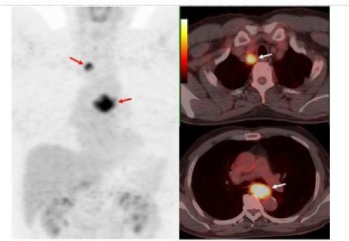 Esophageal-Carcinoma-消化道常见恶性肿瘤介绍2.png 7b3c315e-ebf7-4c80-b0f3-5cf9687ad0e8.png.png