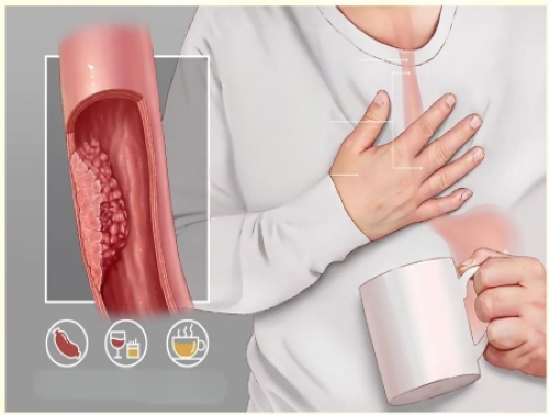 Esophageal-Carcinoma-消化系统常见恶性肿瘤图示.png a5501c61-a33b-453f-b1b0-320a00928666.png.png