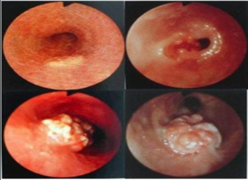 Esophageal-Carcinoma-消化系统常见恶性肿瘤图示1.png fbc60977-f248-415f-96dd-6957ff65db59.png.png