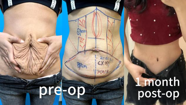 Abdominoplasty Surgeries Case 2: Postpartum Abdominal Restoration after Twin Pregnancy