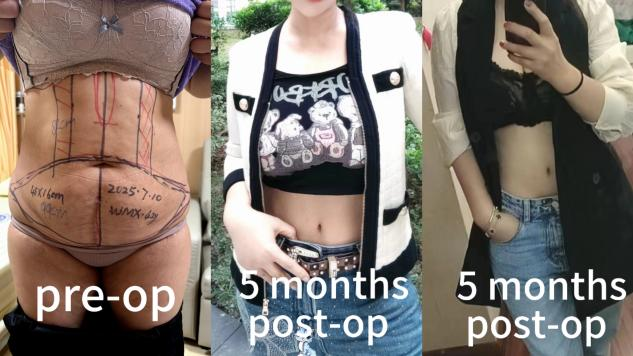 Abdominoplasty Surgeries Case 4: Revision of Vertical Cesarean Scar with Abdominal Contouring