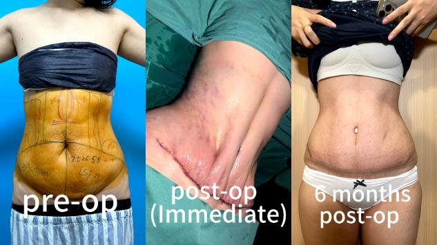 Abdominoplasty Surgeries Case 6: Combined Skin Laxity and Muscle Separation after Pregnancy