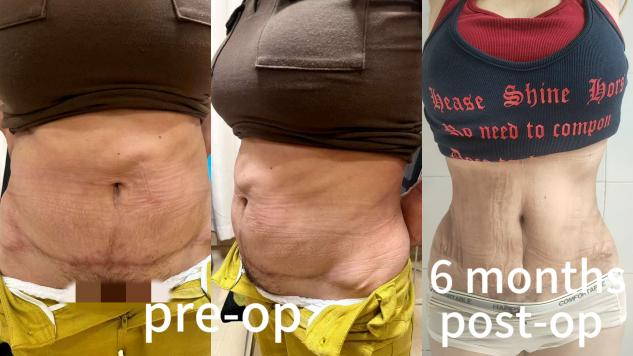 Abdominoplasty Surgeries Case 7: Revision Surgery for Previous Abdominal Contouring