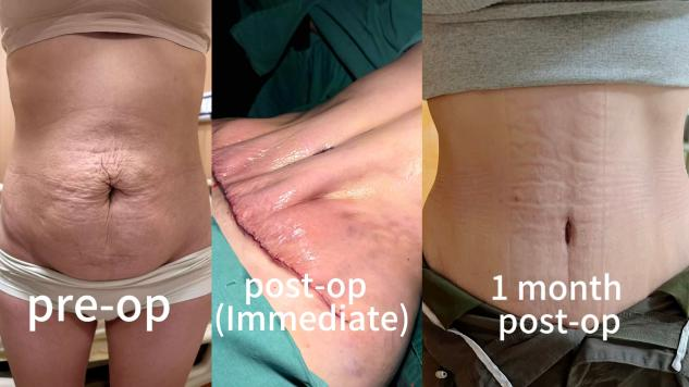 Abdominoplasty Surgeries Case 5: Postpartum Rectus Abdominis Diastasis Correction