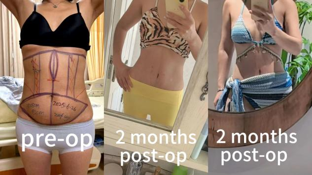 Abdominoplasty Surgeries Case 3: Correction of Abdominal Fat Accumulation and Sagging