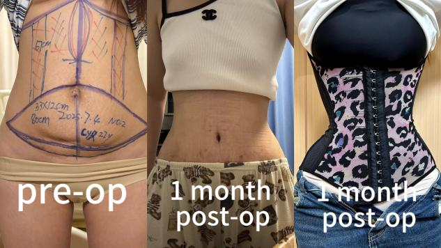 Abdominoplasty Surgeries Case 1: Mild Abdominal Laxity with Umbilical Concern