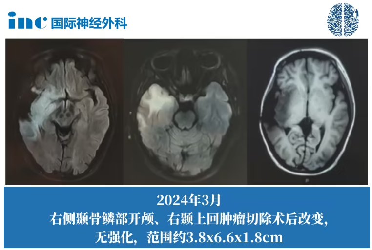 胶质瘤4.3.png