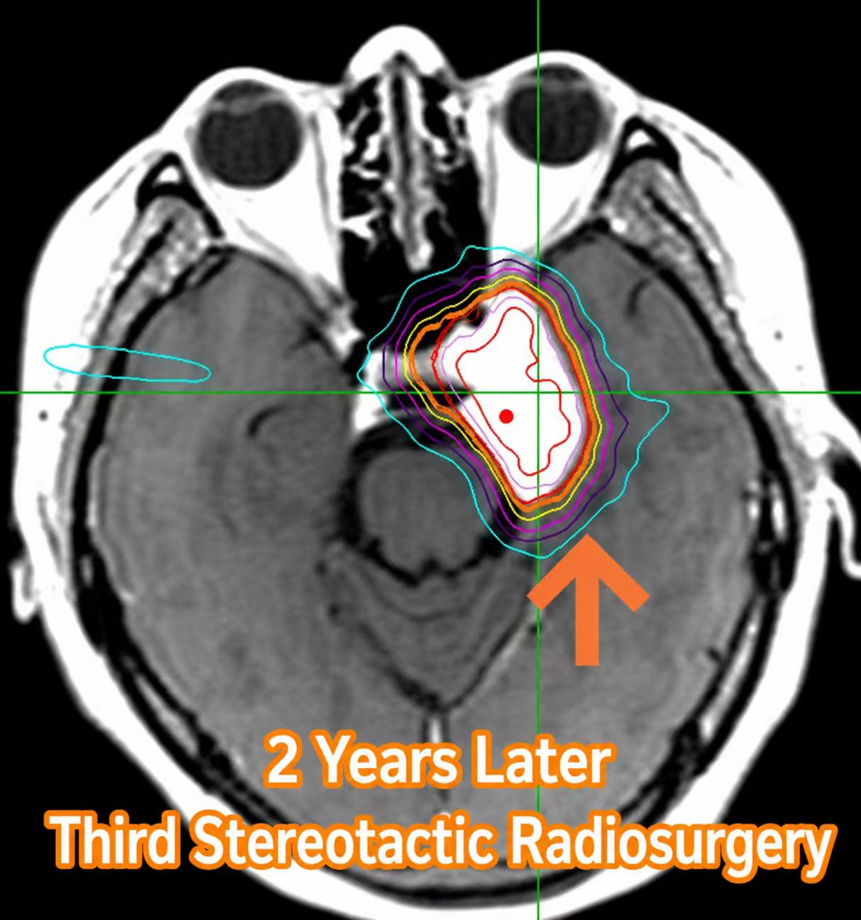 Dua tahun kemudian, dilakukan terapi CyberKnife kedua
